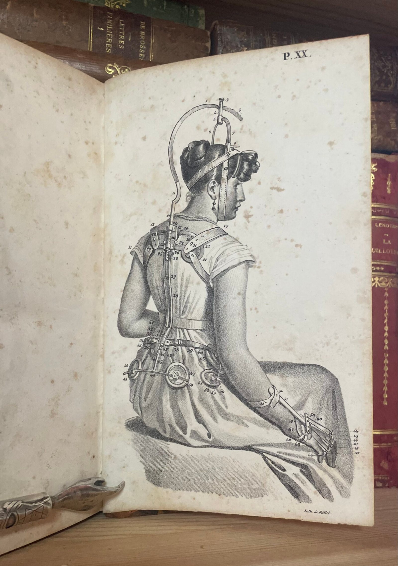 Traité des bandages et appareils de pansement par P. N. Gerdy Paris chez Crevot 1826 - immagine 15