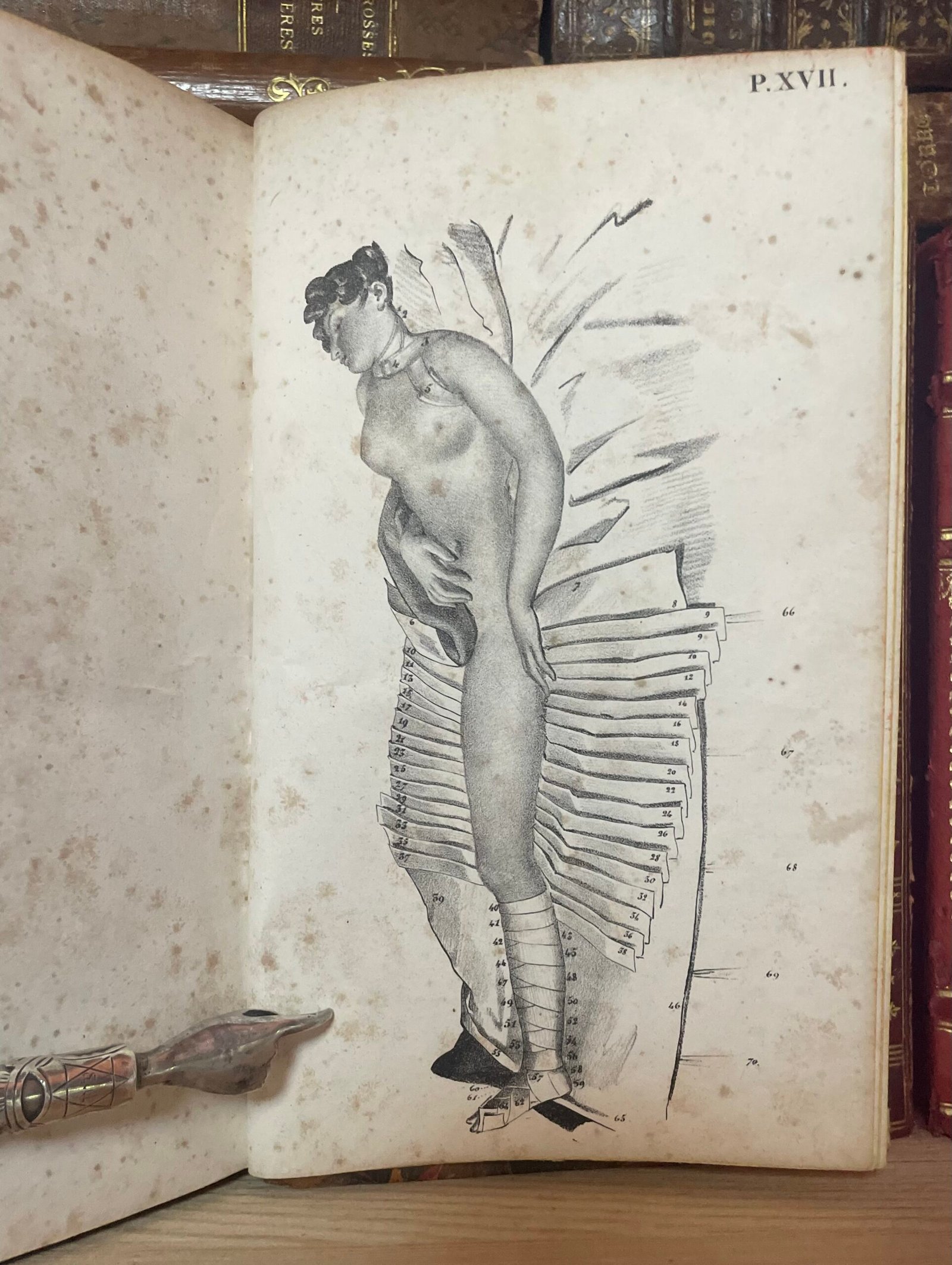 Traité des bandages et appareils de pansement par P. N. Gerdy Paris chez Crevot 1826 - immagine 18