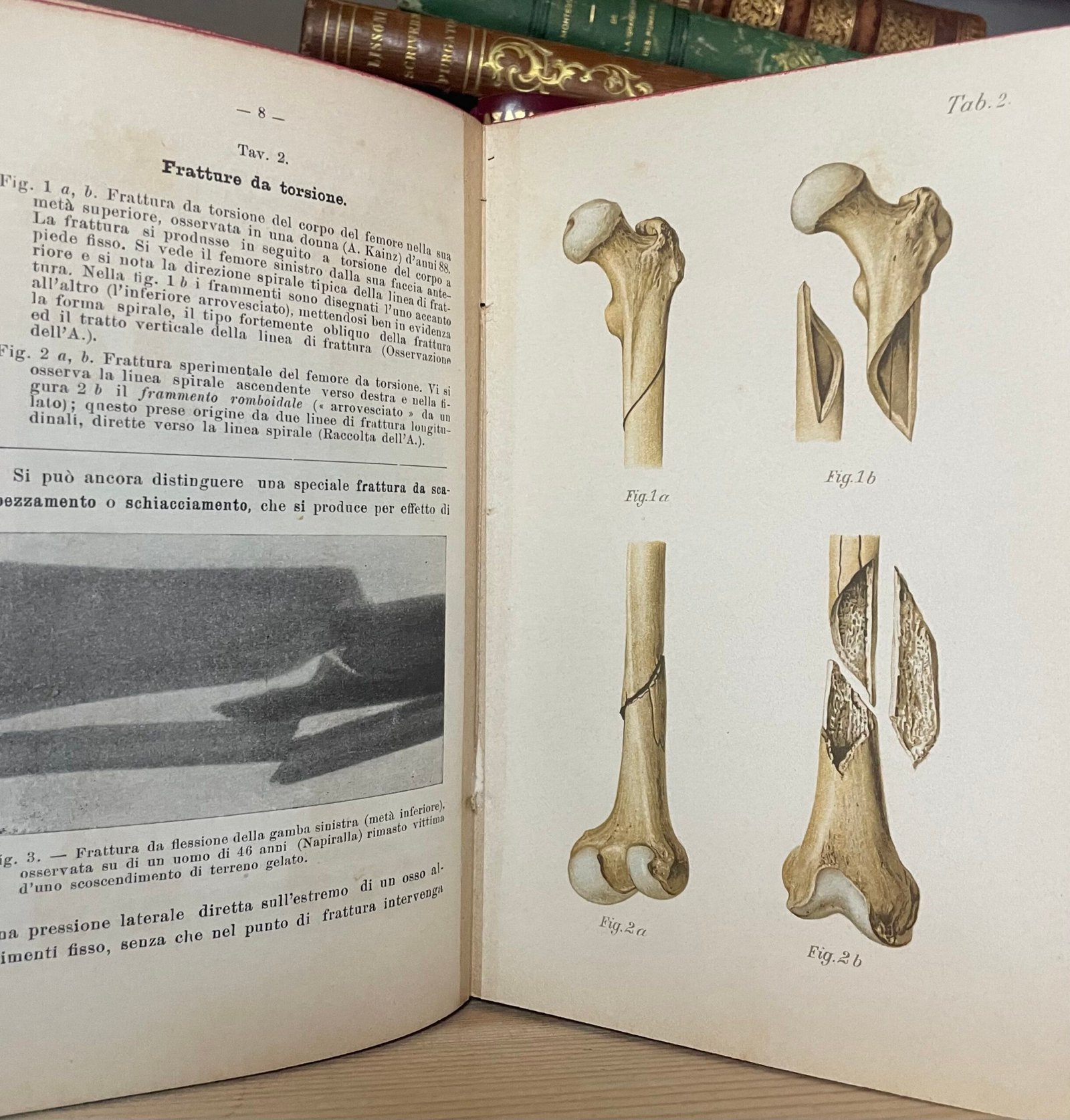 Helferich Atlante e compendio delle fratture e lussazioni traumatiche 1908 - immagine 15