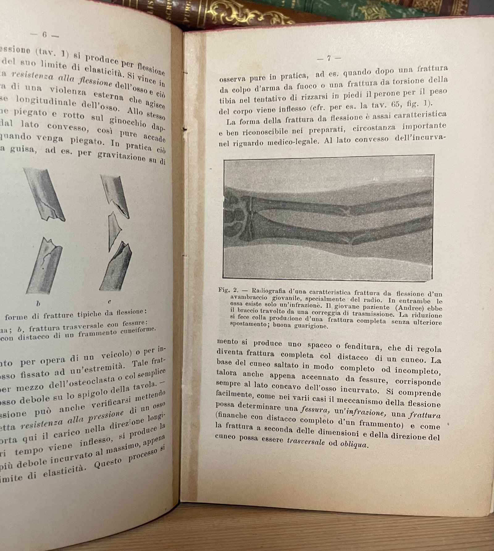 Helferich Atlante e compendio delle fratture e lussazioni traumatiche 1908 - immagine 18