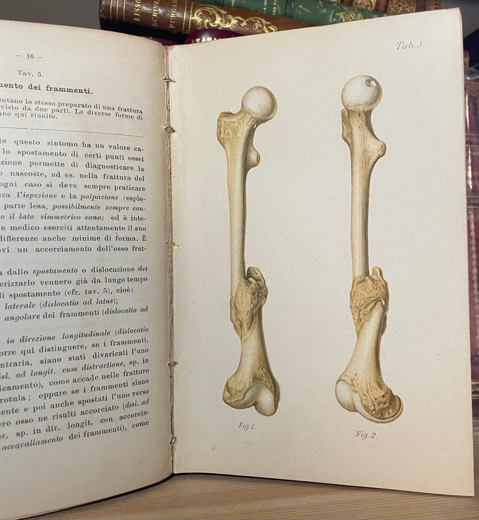Helferich Atlante e compendio delle fratture e lussazioni traumatiche 1908 - immagine 19