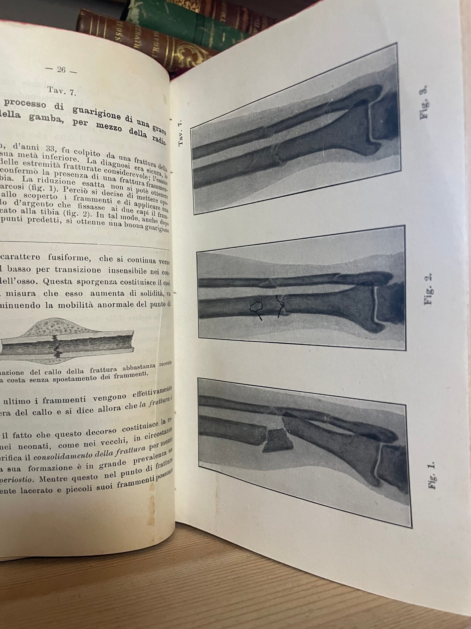 Helferich Atlante e compendio delle fratture e lussazioni traumatiche 1908 - immagine 21