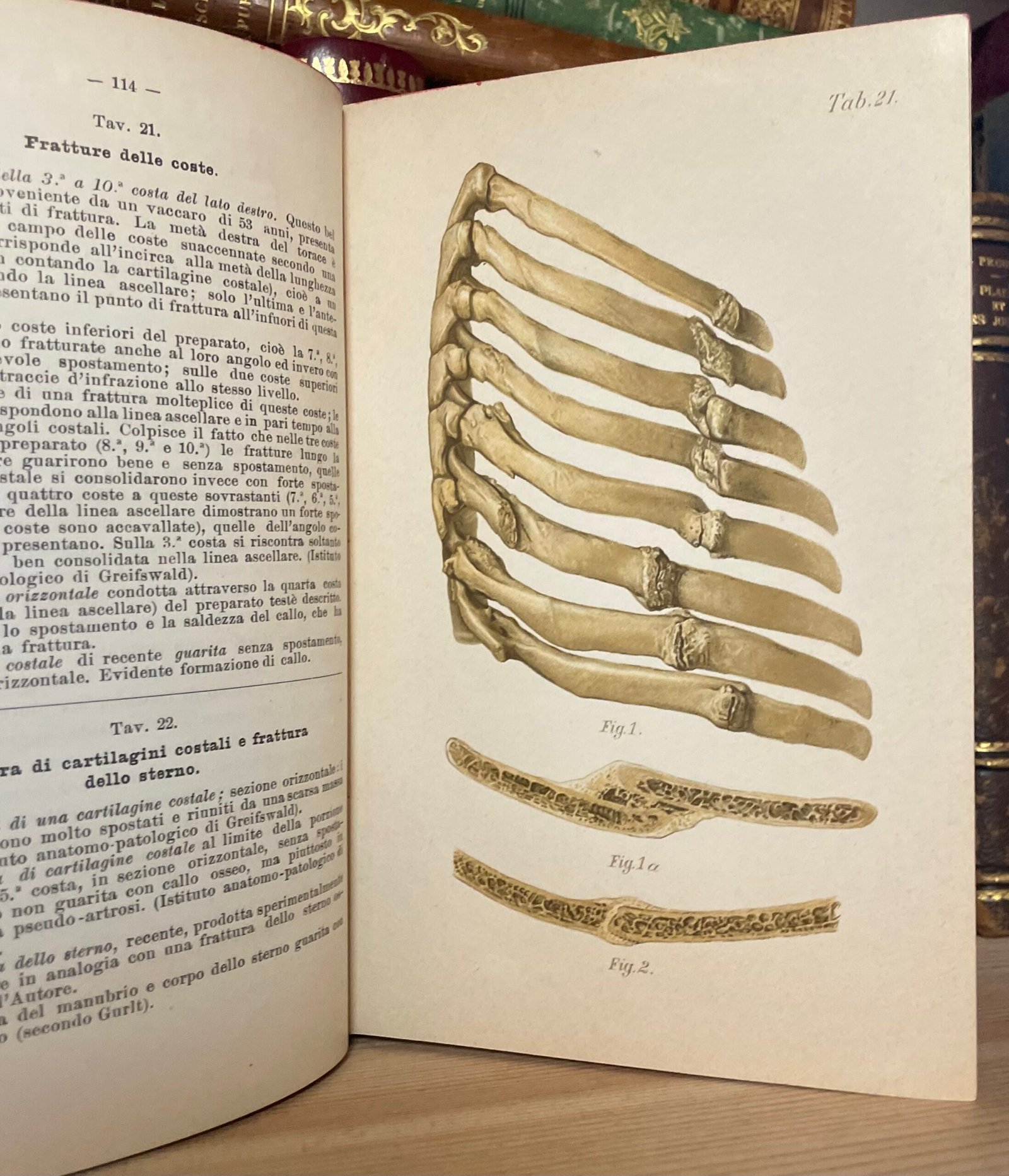 Helferich Atlante e compendio delle fratture e lussazioni traumatiche 1908 - immagine 23