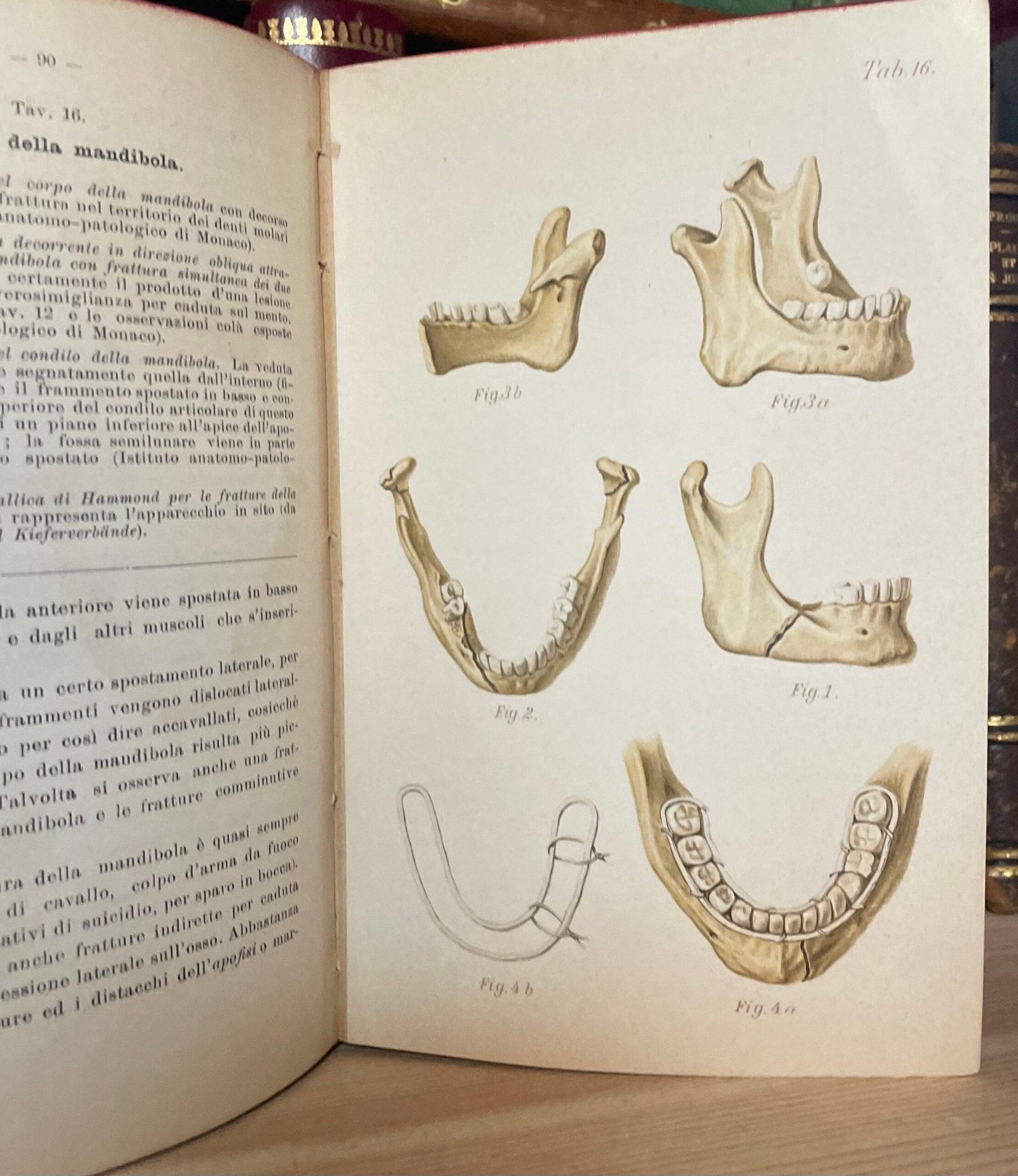 Helferich Atlante e compendio delle fratture e lussazioni traumatiche 1908 - immagine 24