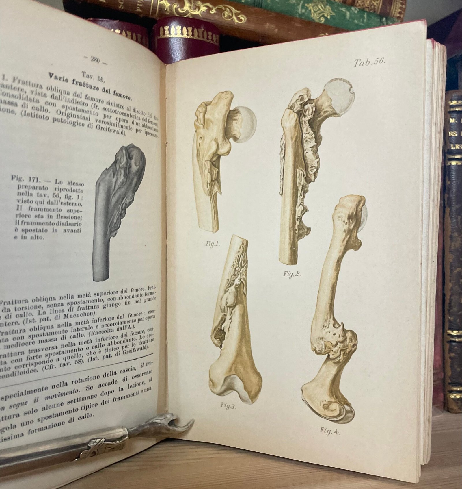 Helferich Atlante e compendio delle fratture e lussazioni traumatiche 1908 - immagine 25